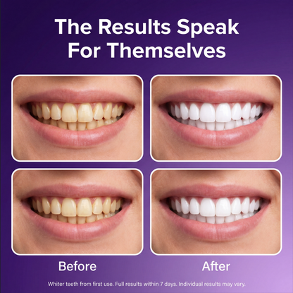 Teeth Whitening Strips